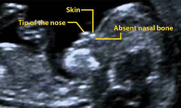 Absent Nasal Bone