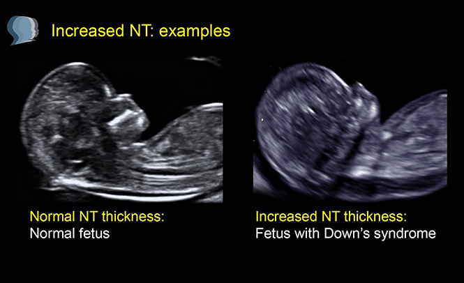 NT Scan