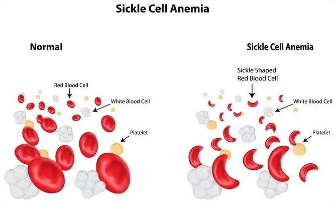 Thalassemia & Sickle Cell Disease