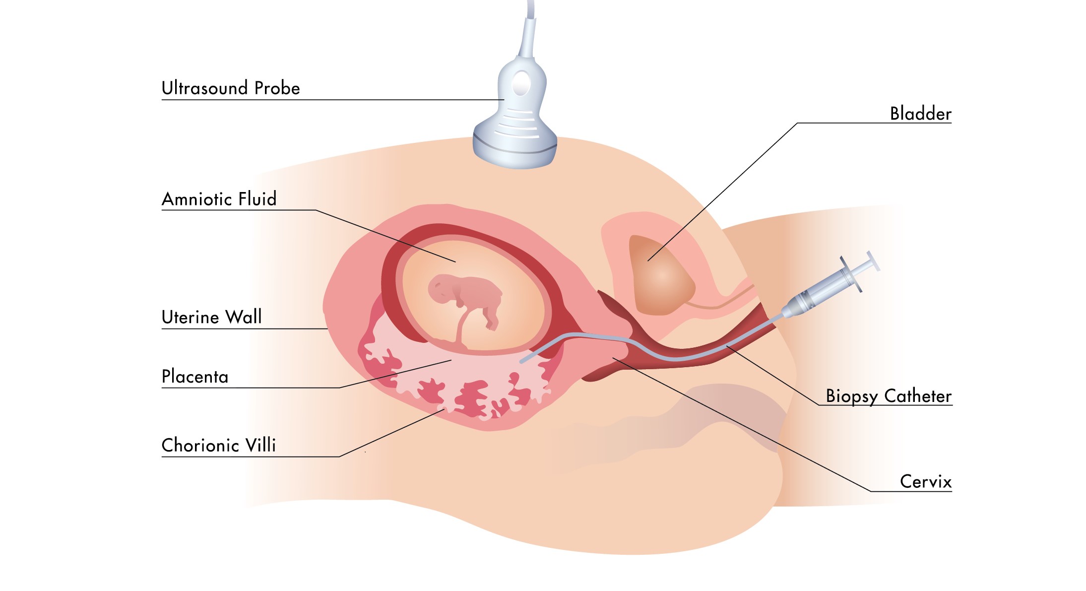 Amniocentesis